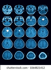 MRI Of The Brain Case Of Pituitary Mass, Transverse View