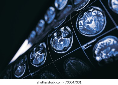 MRI Of Brain, Concept Of The Mysteries Of The Human Mind.