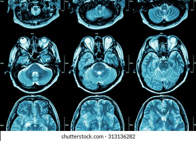 MRI of Brain ( cross section of brain ) ( Medical , Health care , Science background ) - Powered by Shutterstock