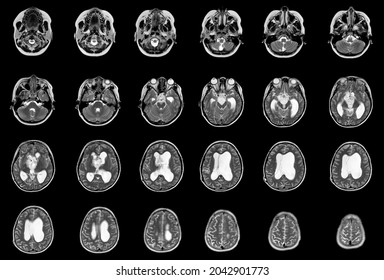 MRI Brain FINDINGS: There Is A 3.5cm Diameter Lobulated Mass At Suprasellar With Compression Of The Pituitary Gland, Severe Dilatation Of Both Lateral Ventricles, Medical Healthcare Concept.