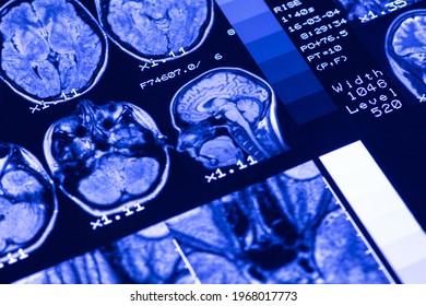 MRI Of  Brain Of A Healthy Person With Blue Illumination. Magnetic Resonance Scan. Medical Healthcare Concept