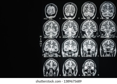 MRI Of  Brain Of A Healthy Person With Gray Illumination. Magnetic Resonance Scan. Medical Healthcare Concept