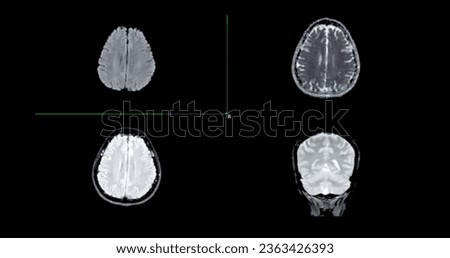 MRI  brain scan  axial Diffusion technique and coronal gredient  for detect  Brain  diseases sush as stroke disease, Brain tumors and Infections.