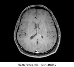 MRI  brain scan  Axial SWI  for detect  Brain  diseases sush as stroke disease, Brain tumors and Infections.
