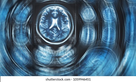 Mri brain scan background, magnetic resonance  tomography, with blur circle motion effect