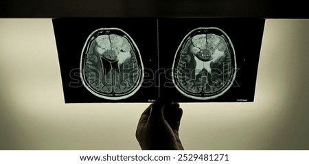 MRI brain scan with contra Compare axial flair and axial t2 weighted for detect Brain diseases such as stroke disease, tumors and Infections. mri head with contrast showing tumor brain.