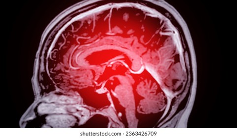 MRI  brain scan  for detect  Brain  diseases sush as stroke disease, Brain tumors and Infections.