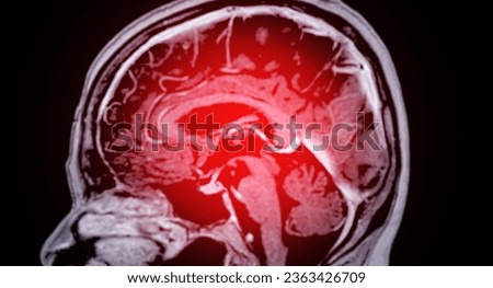 MRI  brain scan  for detect  Brain  diseases sush as stroke disease, Brain tumors and Infections.