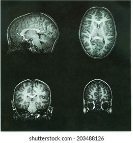 MRI Brain Scan Of A Pre-teen Child's Brain