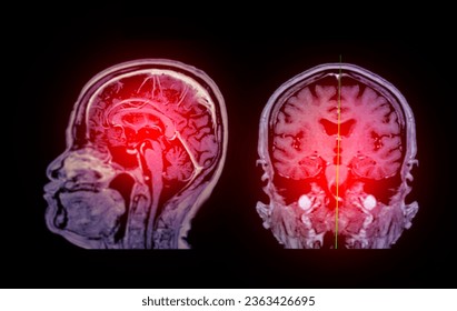 MRI  brain scan Sagittal and coronal view with reference line for detect  Brain  diseases sush as stroke disease, Brain tumors and Infections.