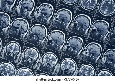 MRI Brain Scan Or X-ray Neurology Human Head Skull Tomography Test, CT Scan Research 