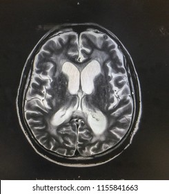 MRI Brain Showed Hydrocephalus With Clinical Of Normal Pressure Hydrocephalus , Ataxia,cognitive Decline,incontinence