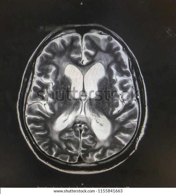 MRI\
brain showed hydrocephalus with clinical of normal pressure\
hydrocephalus , ataxia,cognitive\
decline,incontinence