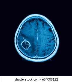 MRI Of The Brain, Showing Brain Abscess (or Cerebral Abscess)