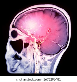 MRI  Brain T1 Sagittal Plane With 3D Rendering CTA Brain .