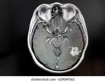 MRI Of Brain Tumour