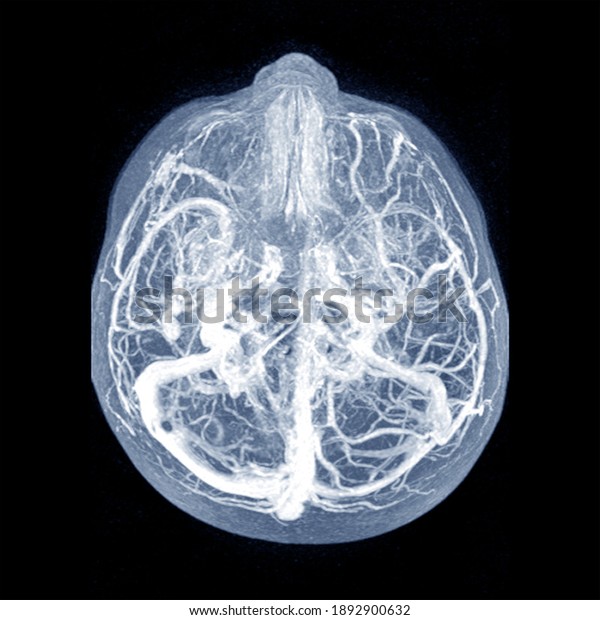 Mri Brainmoderate Perilesional Vasogenic Edema 07 Stock Photo ...