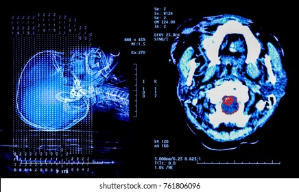 MRI of the brain.X-ray film of the brain computed tomography.