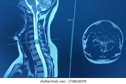 MRI CERVICAL SPINE HISTORY A 16 Year Old Female Presented With Progressive And Paresthesia Of The Leg For 2 Month.Finding A Lage Mass In The Enlarged Right C6-7 Neural Foramen And Extending To Rt.side