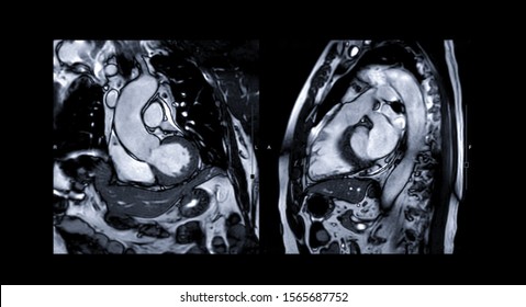 MRI heart or Cardiac MRI ( magnetic resonance imaging ) of heart compare RVOT and LVOT for diagnosis heart disease.