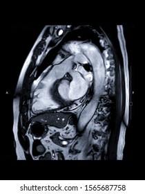 MRI Heart Or Cardiac MRI ( Magnetic Resonance Imaging ) Of Heart  LVOT View For Diagnosis Heart Disease.