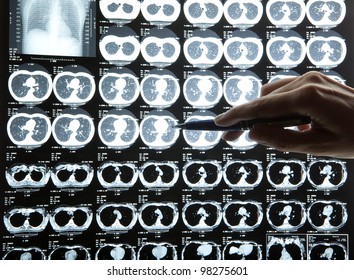 MRI Of Human Heart And Lungs