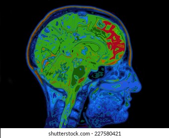 MRI Image Of Head Showing Brain