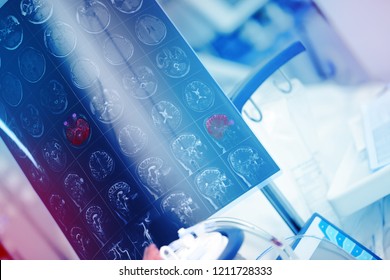 MRI Image Of Human Brain With Red Color Marked Focal Lesion In The Hospital Room.