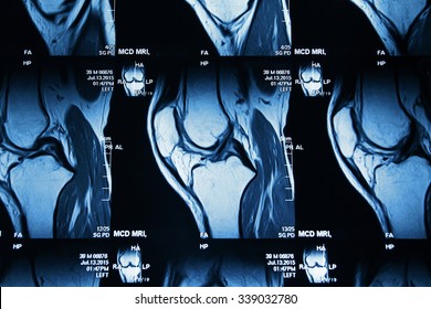 MRI Image Of Knee Joint Leg