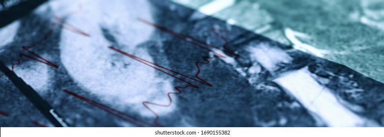 MRI Image Lying Over Cardiogram Chart Close-up. Comparison Medical Indicators Patient. Making Correct Diagnosis. Inpatient Treatment And Diagnosis. Rehabilitation Healthy After An Injury