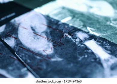 MRI Image Lying Over Cardiogram Chart Close-up. Comparison Medical Indicators Patient. Making Correct Diagnosis. Inpatient Treatment And Diagnosis. Rehabilitation Healthy After An Injury