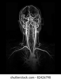 MRI Image (MRA) Show Head And Neck Artery And Vein