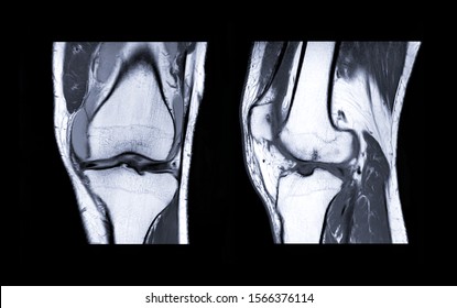 MRI Knee joint or Magnetic resonance imaging  compare coronal and sagittal view for detect tear or sprain of the anterior cruciate  ligament (ACL).