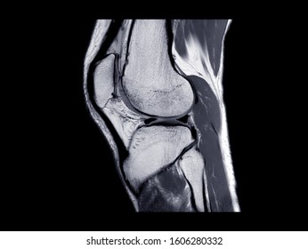 MRI Knee Joint Or Magnetic Resonance Imaging  Sagittal View For Detect Tear Or Sprain Of The Anterior Cruciate  Ligament (ACL).