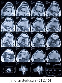 MRI Of Knee In Top View.