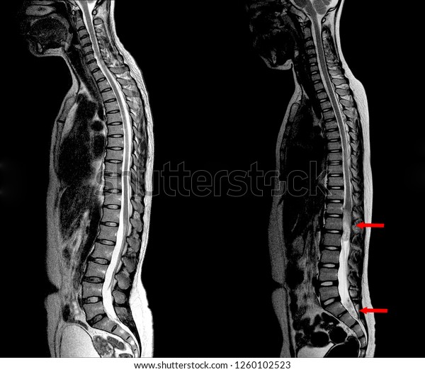 Mri Lumbar Spine First View Normal Foto de stock 1260102523 | Shutterstock