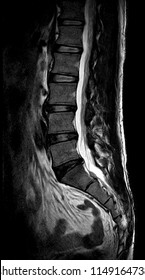 MRI Lumbar spine , Sagital T2 wight Show mild lumbar spine Spondylosis disc bulging at L4-5 and L5-S1 mild stenosis. 