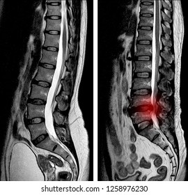 MRI Lumbar Spine Scan Sagittal View Lumbosacral Spine Has Straightening Lumbar Alignment, Herniated Nucleus Pulposus Back Pain Patient. 