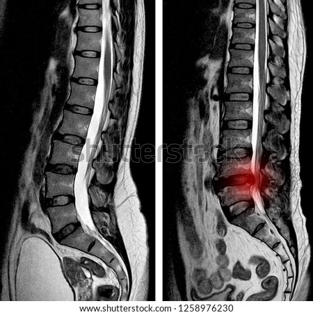 MRI Lumbar spine scan sagittal view Lumbosacral spine has straightening lumbar alignment, Herniated nucleus pulposus back pain patient. 