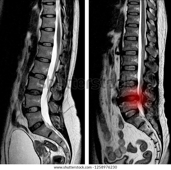 MRI Lumbar spine scan sagittal view Lumbosacral spine\
has straightening lumbar alignment, Herniated nucleus pulposus back\
pain patient. 