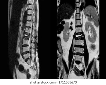 Mri Lumbar Spine Study Reveals Burst Stock Photo (Edit Now) 1711533673