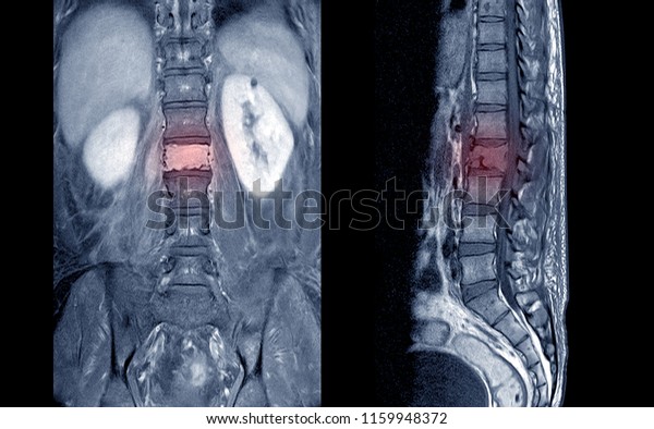 Mri Lumbosacral Spinea 30 Yearold Male Stock Photo (Edit Now) 1159948372