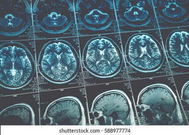 MRI Or Magnetic Resonance Image Of Head And Brain Scan. Close Up View, Toned Image