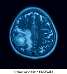 MRI (magnetic resonance imaging) of the brain (With intravenous contrast administration, case of Intracerebral hemorrhage(HTC), transverse view 