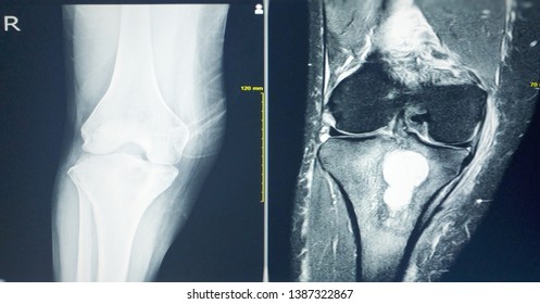 MRI OF THE RIGHT KNEE History: Right Knee Pain, R/O TB Arthritis Or Bone Tumor.Localized Mild Osteosclerosis Plus 4.5 Cm Lytic Lesion At Irhgt Upper Tibia. No Periosteal Reaction Is Seen. Bone Tumor. 