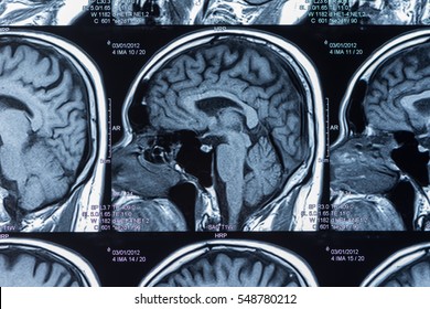 Mri Scan Of Brain By Computer Tomography.