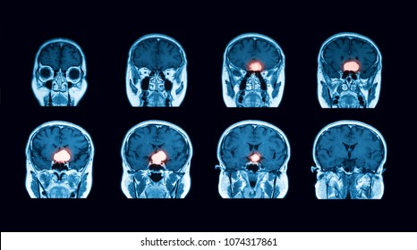 MRI Scan Of The Brain, Coronal View,  Case Of Pituitary Mass