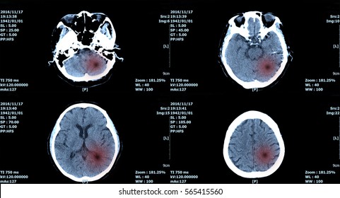 MRI Scan Brain, Ct Scan Of Brain Image For Diagnosis Hemorrhage, Tumor.