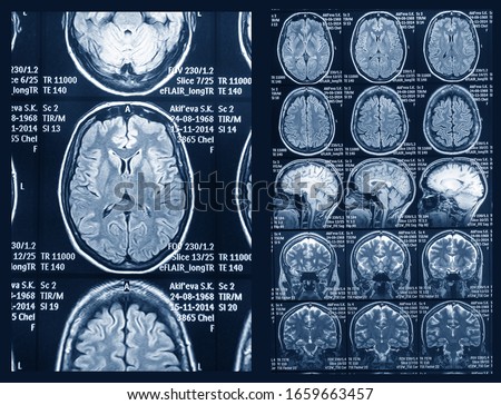 MRI scan of the brain for diagnosis. Medical examination for health prevention.