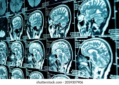 MRI scan of the brain, medical examination of the brain